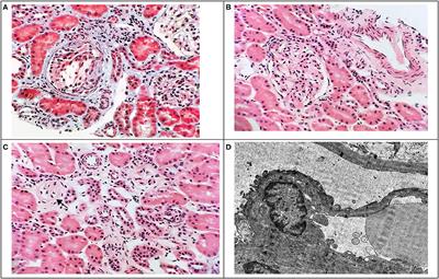 Dent Disease Type 2 as a Cause of Focal Segmental Glomerulosclerosis in a 6-Year-Old Boy: A Case Report